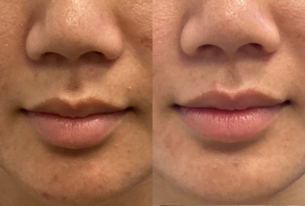 Before and after image of a lower face with acne issues.