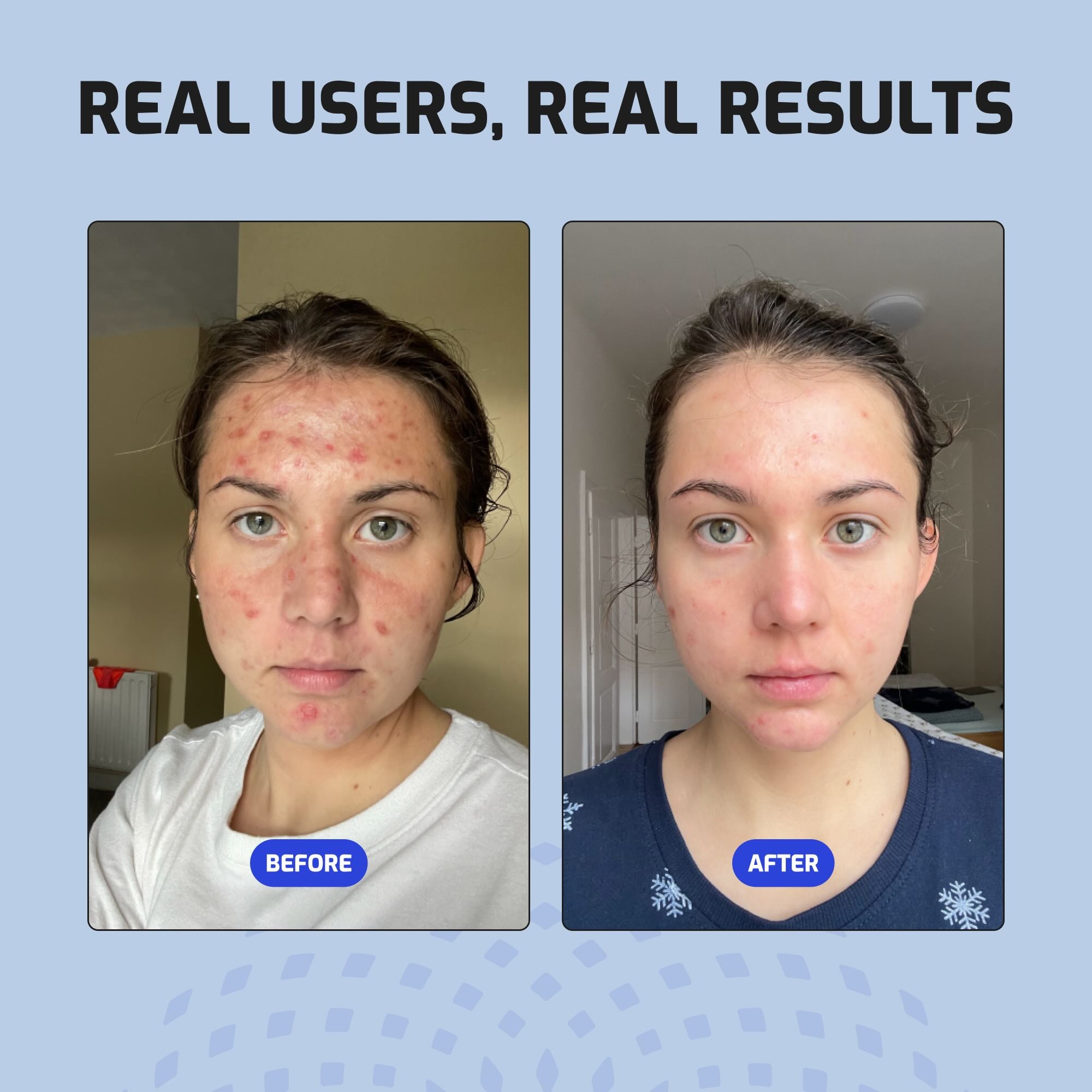 Before after image of a woman with acne.