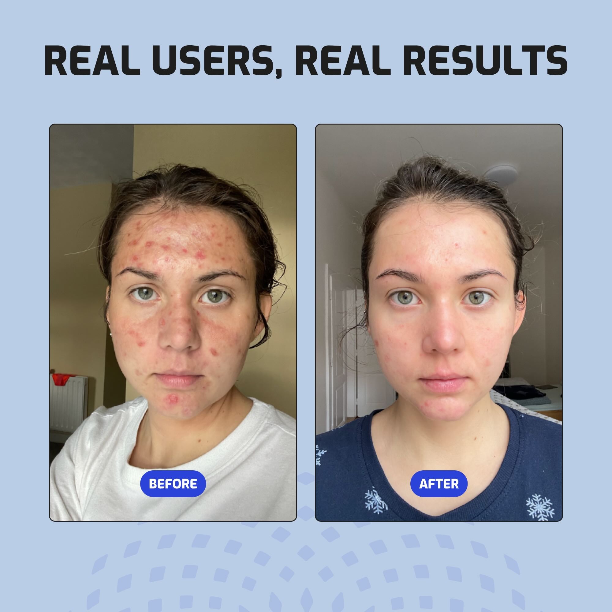Body Acne (Bacne) System