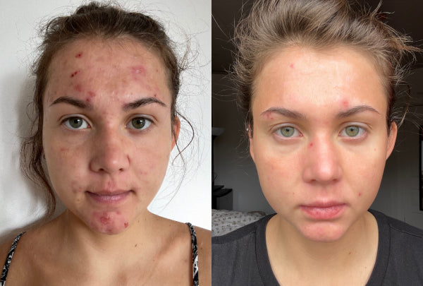 Before and after image of a woman with acne issues.