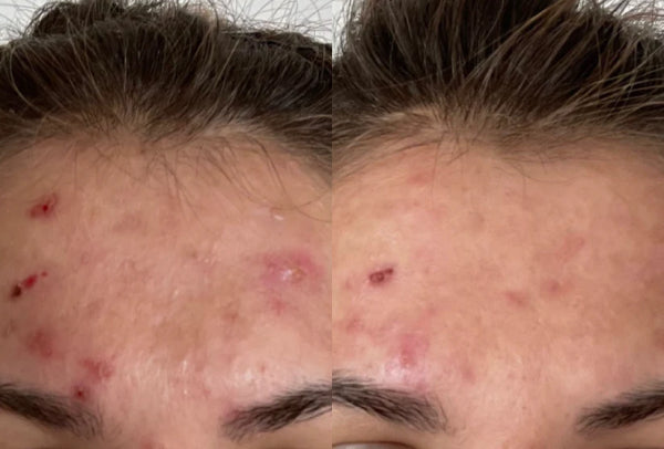 Before and after image of a forehead with acne issues.